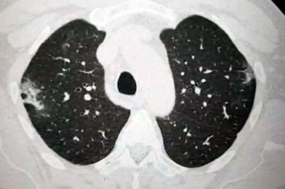 Lungs of a coronavirus patient (video)