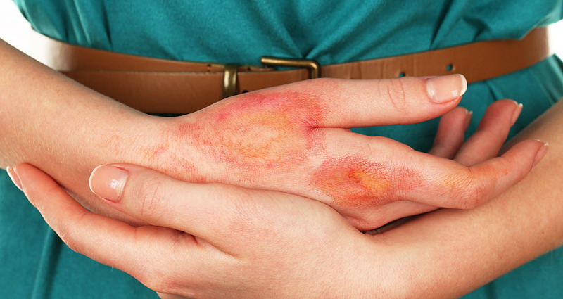 What you need to know about chemical burns